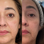 Intensive Collagen Therapy